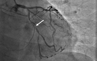 燕達研究院：成功開展CD19 CAR-T細胞治療白血病臨床研究